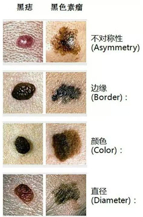 痣長在臉上|是痣還是瘤？黑色素瘤的類型、症狀與治療